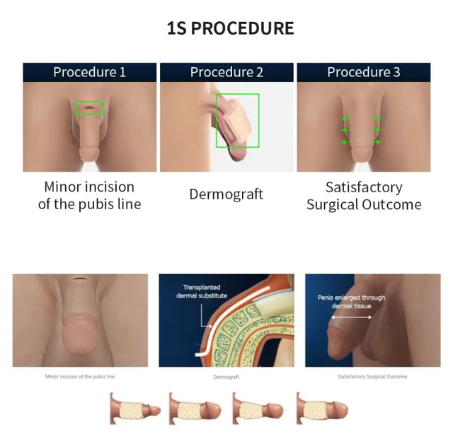 1 Penis Enlargement Surgery in Korea Seoul Proud Urology Clinic